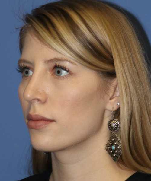 Rhinoplasty 5473 – Click HERE for more views after photo. Individual results may vary.