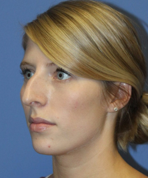Rhinoplasty 5473 – Click HERE for more views before photo. Individual results may vary.