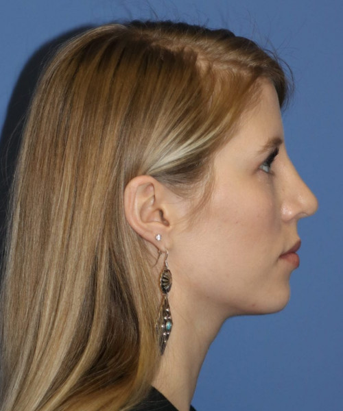 Rhinoplasty 5473 – Click HERE for more views after photo. Individual results may vary.