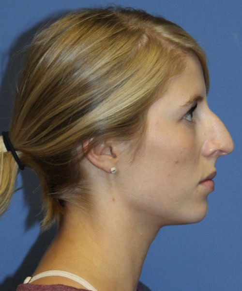 Rhinoplasty 5473 – Click HERE for more views before photo. Individual results may vary.