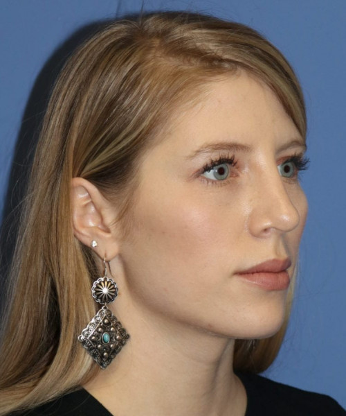 Rhinoplasty 5473 – Click HERE for more views after photo. Individual results may vary.