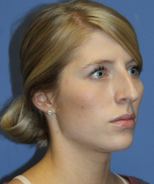 Rhinoplasty 5473 – Click HERE for more views before photo. Individual results may vary.