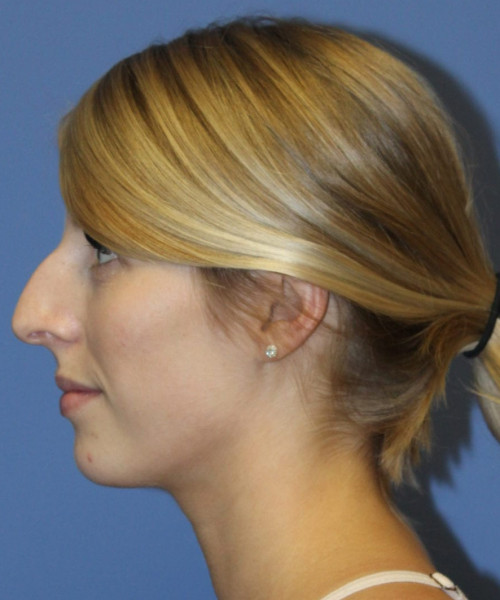 Rhinoplasty 5473 – Click HERE for more views before photo. Individual results may vary.