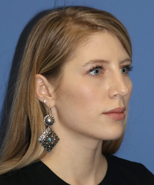 Rhinoplasty 5473 – Click HERE for more views after photo. Individual results may vary.