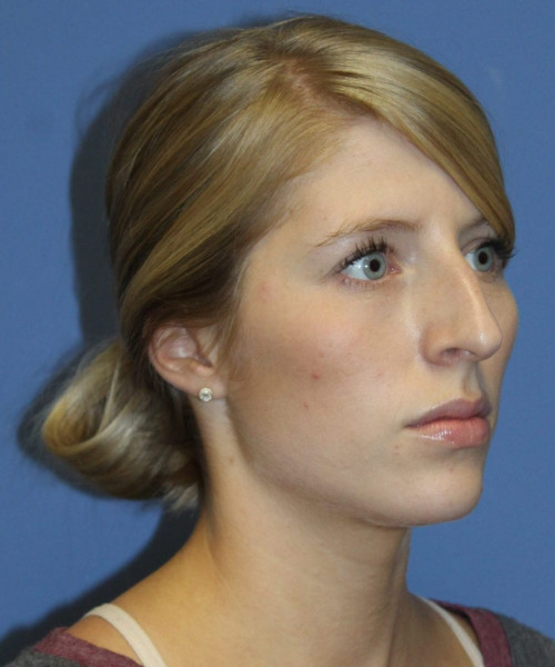 Rhinoplasty 5473 – Click HERE for more views before photo. Individual results may vary.
