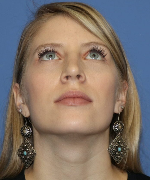 Rhinoplasty 5473 – Click HERE for more views after photo. Individual results may vary.