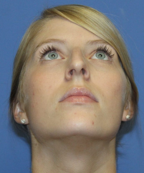 Rhinoplasty 5473 – Click HERE for more views before photo. Individual results may vary.