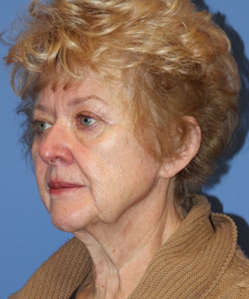 Blepharoplasty (eyelids) 5490 – Click HERE for more views after photo. Individual results may vary.