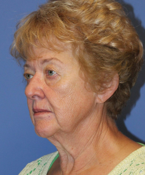 Blepharoplasty (eyelids) 5490 – Click HERE for more views before photo. Individual results may vary.