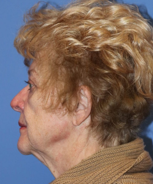Blepharoplasty (eyelids) 5490 – Click HERE for more views after photo. Individual results may vary.