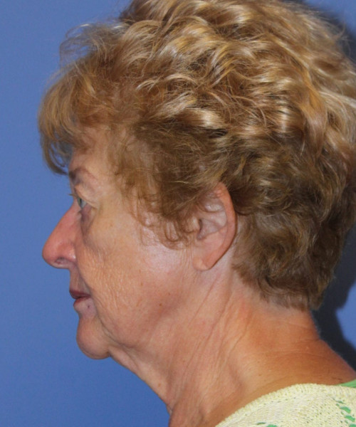 Blepharoplasty (eyelids) 5490 – Click HERE for more views before photo. Individual results may vary.