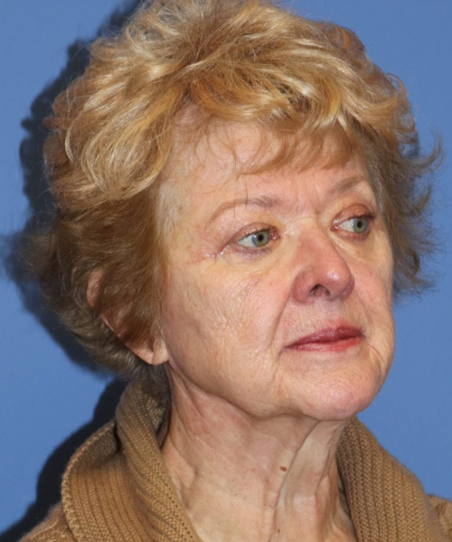 Blepharoplasty (eyelids) 5490 – Click HERE for more views after photo. Individual results may vary.