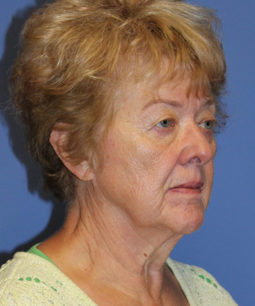 Blepharoplasty (eyelids) 5490 – Click HERE for more views before photo. Individual results may vary.