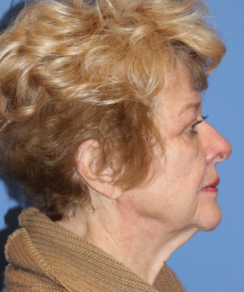 Blepharoplasty (eyelids) 5490 – Click HERE for more views after photo. Individual results may vary.