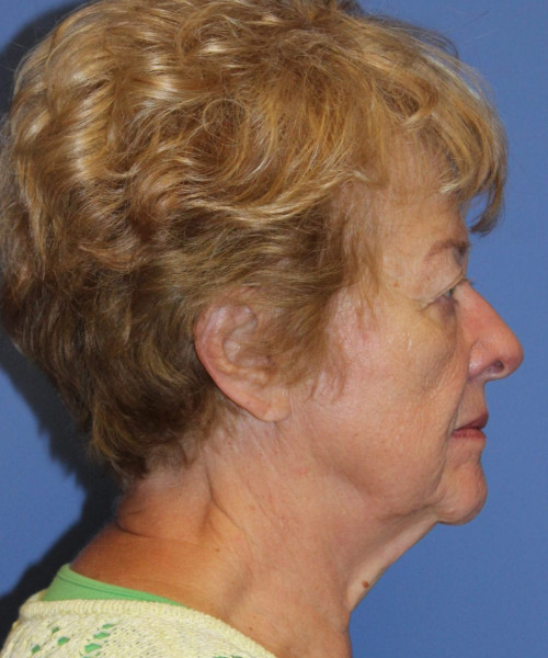 Blepharoplasty (eyelids) 5490 – Click HERE for more views before photo. Individual results may vary.