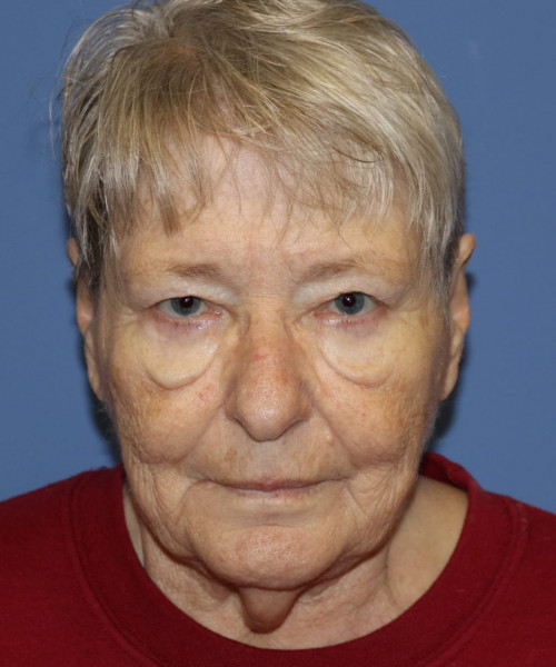 Blepharoplasty (eyelids) 5505 – Click HERE for more views after photo. Individual results may vary.