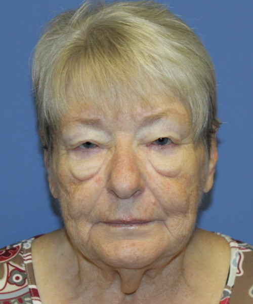 Blepharoplasty (eyelids) 5505 – Click HERE for more views before photo. Individual results may vary.