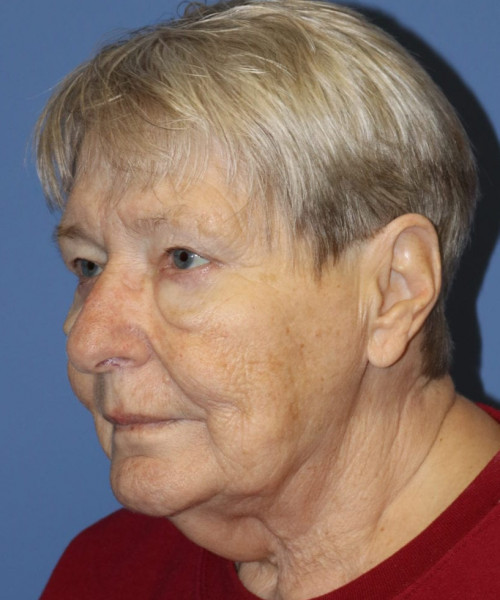 Blepharoplasty (eyelids) 5505 – Click HERE for more views after photo. Individual results may vary.