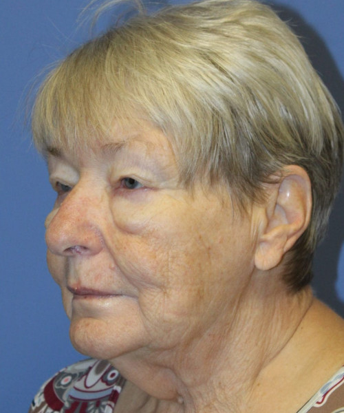 Blepharoplasty (eyelids) 5505 – Click HERE for more views before photo. Individual results may vary.