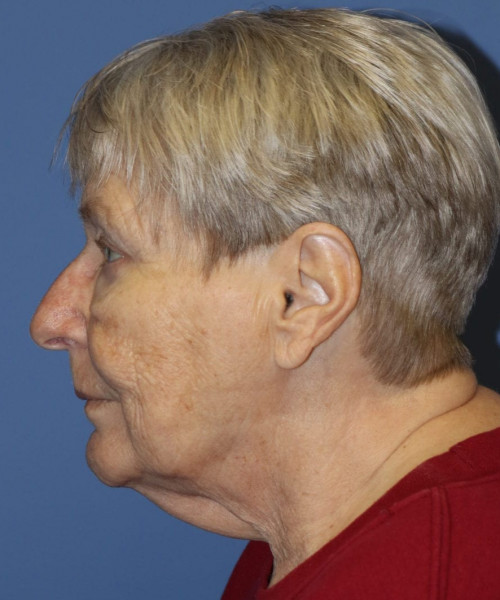 Blepharoplasty (eyelids) 5505 – Click HERE for more views after photo. Individual results may vary.