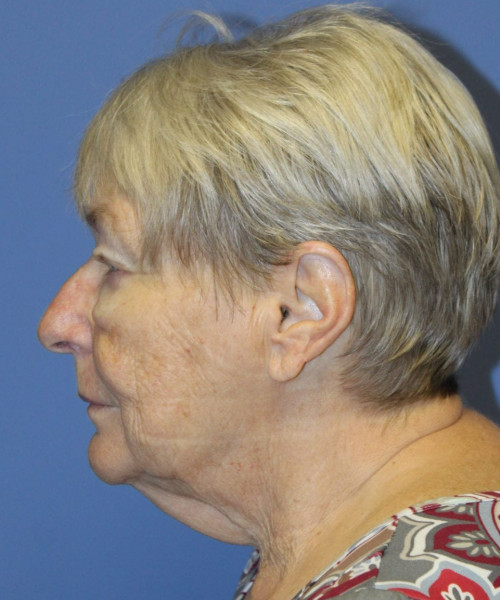 Blepharoplasty (eyelids) 5505 – Click HERE for more views before photo. Individual results may vary.
