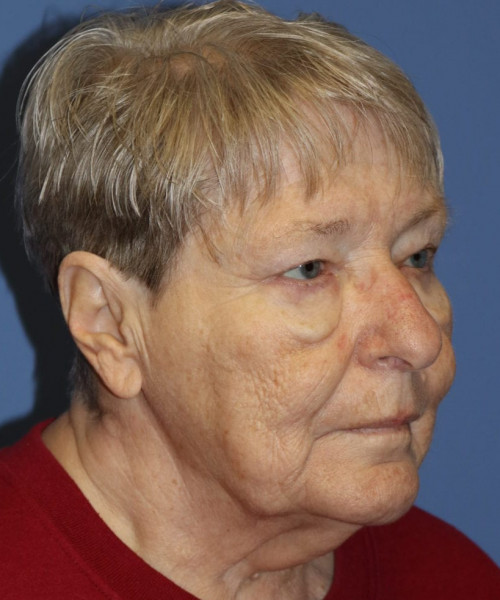 Blepharoplasty (eyelids) 5505 – Click HERE for more views after photo. Individual results may vary.