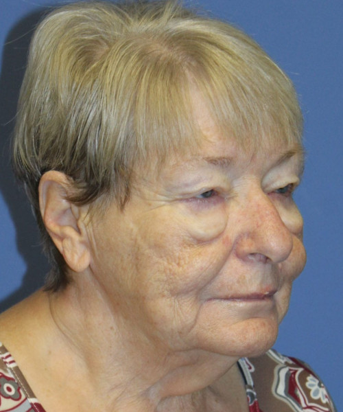 Blepharoplasty (eyelids) 5505 – Click HERE for more views before photo. Individual results may vary.