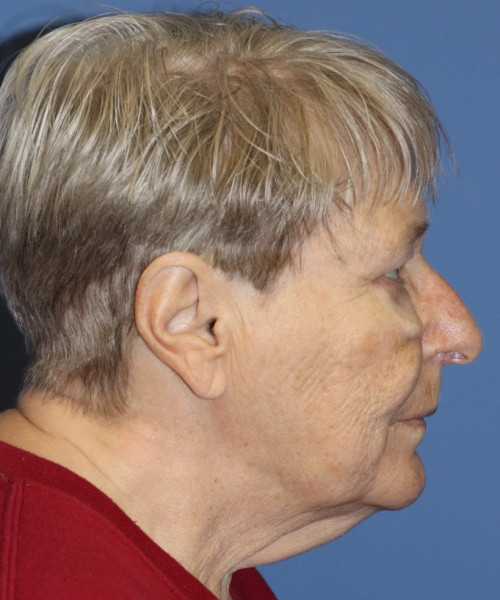 Blepharoplasty (eyelids) 5505 – Click HERE for more views after photo. Individual results may vary.