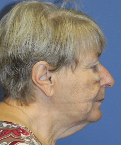 Blepharoplasty (eyelids) 5505 – Click HERE for more views before photo. Individual results may vary.