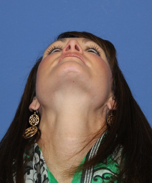 Rhinoplasty 0554 – Click HERE for more views after photo. Individual results may vary.