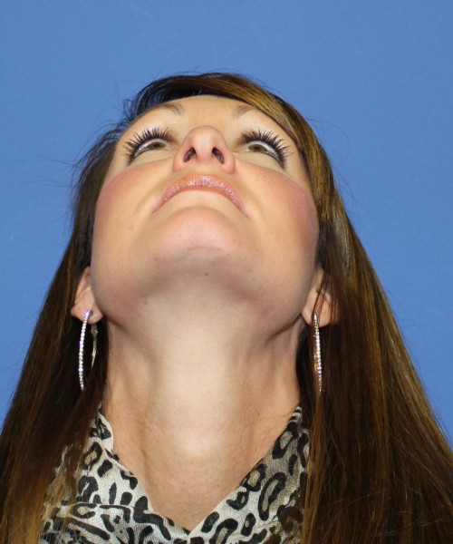 Rhinoplasty 0554 – Click HERE for more views before photo. Individual results may vary.