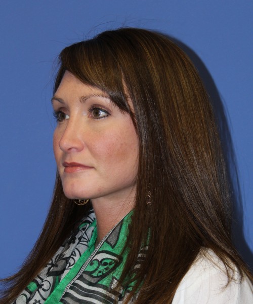 Rhinoplasty 0554 – Click HERE for more views after photo. Individual results may vary.