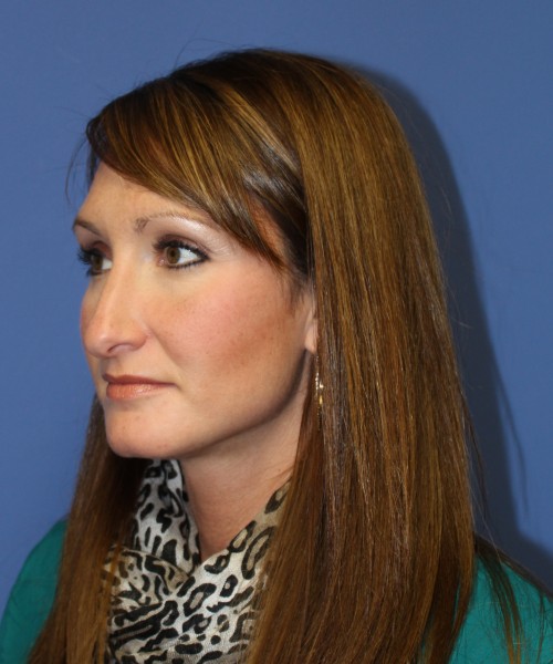 Rhinoplasty 0554 – Click HERE for more views before photo. Individual results may vary.