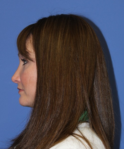 Rhinoplasty 0554 – Click HERE for more views after photo. Individual results may vary.