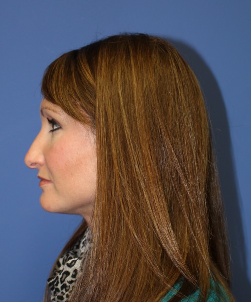 Rhinoplasty 0554 – Click HERE for more views before photo. Individual results may vary.