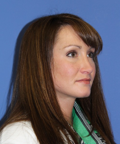 Rhinoplasty 0554 – Click HERE for more views after photo. Individual results may vary.