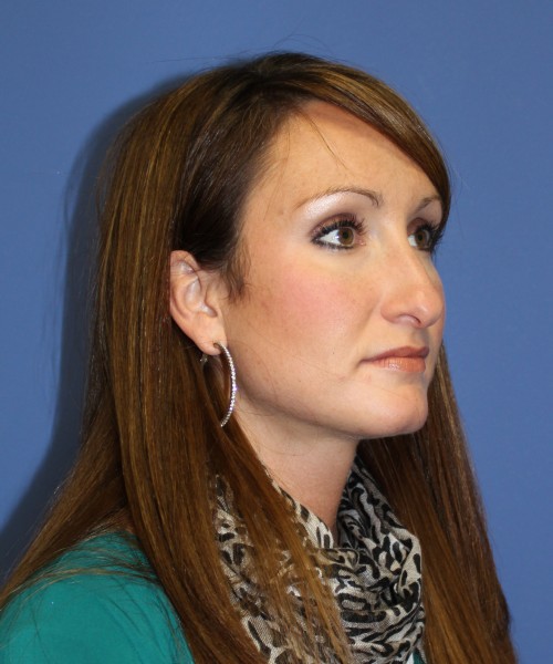 Rhinoplasty 0554 – Click HERE for more views before photo. Individual results may vary.