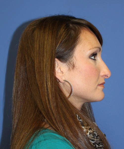 Rhinoplasty 0554 – Click HERE for more views before photo. Individual results may vary.