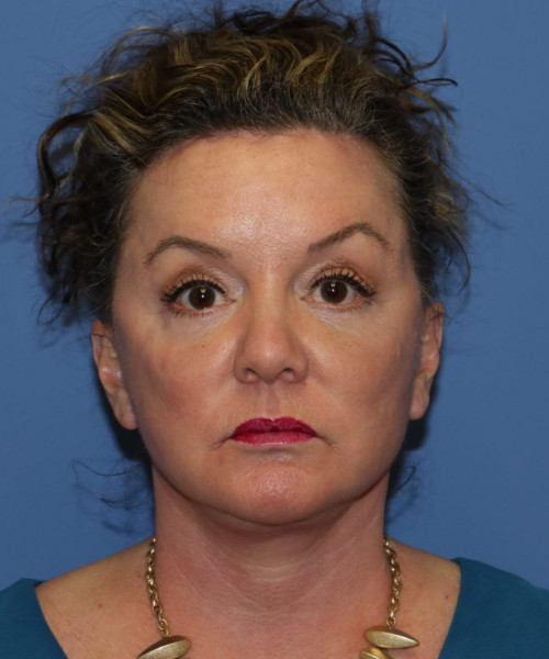 Facelift, Browlift, Hairline Advancement, Blepharoplasty, SMAS Lip Augmentation 5544 – Click HERE for more views after photo. Individual results may vary.