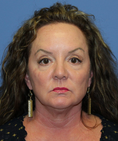 Facelift, Browlift, Hairline Advancement, Blepharoplasty, SMAS Lip Augmentation 5544 – Click HERE for more views before photo. Individual results may vary.