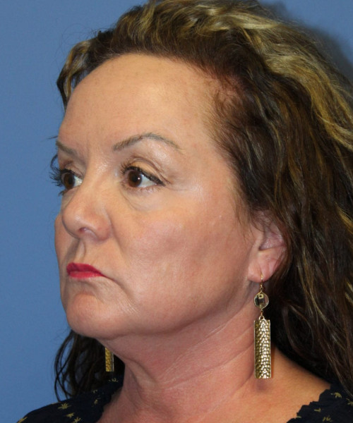 Facelift, Browlift, Hairline Advancement, Blepharoplasty, SMAS Lip Augmentation 5544 – Click HERE for more views before photo. Individual results may vary.