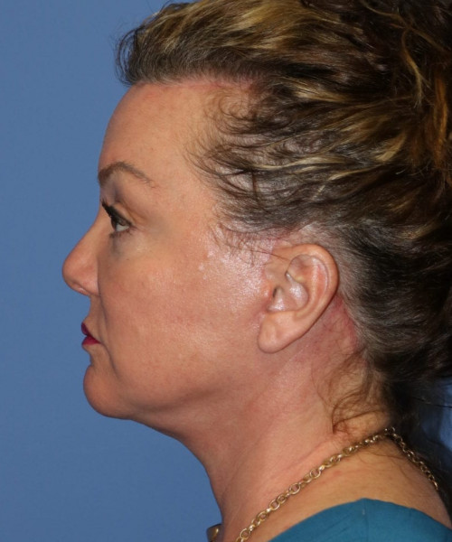 Facelift, Browlift, Hairline Advancement, Blepharoplasty, SMAS Lip Augmentation 5544 – Click HERE for more views after photo. Individual results may vary.