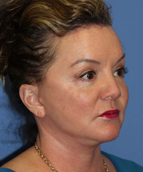 Facelift, Browlift, Hairline Advancement, Blepharoplasty, SMAS Lip Augmentation 5544 – Click HERE for more views after photo. Individual results may vary.