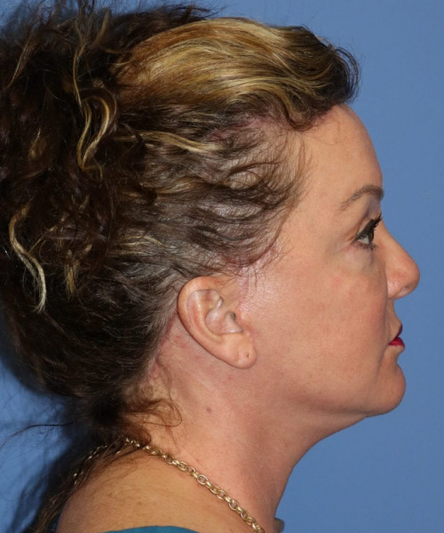 Facelift, Browlift, Hairline Advancement, Blepharoplasty, SMAS Lip Augmentation 5544 – Click HERE for more views after photo. Individual results may vary.