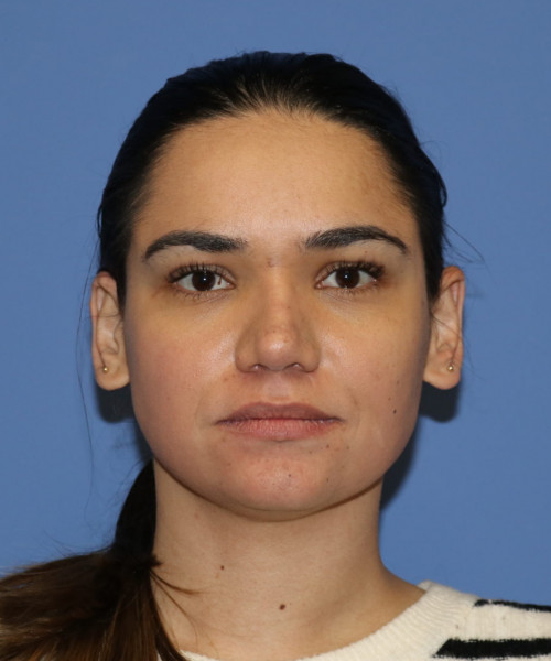 Rhinoplasty 5564 – Click HERE for more views after photo. Individual results may vary.
