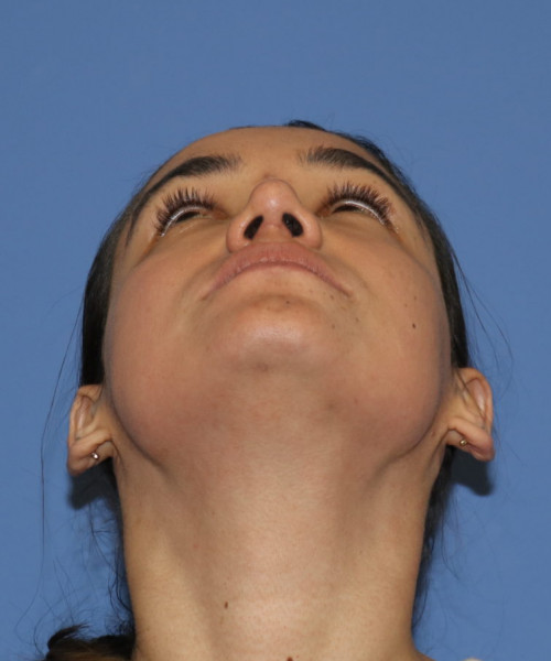 Rhinoplasty 5564 – Click HERE for more views after photo. Individual results may vary.