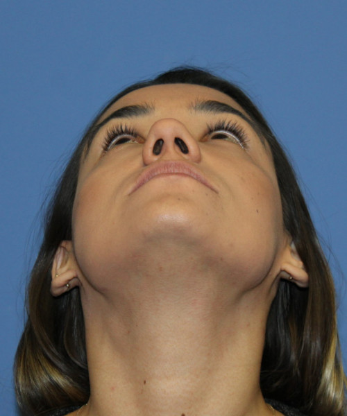 Rhinoplasty 5564 – Click HERE for more views before photo. Individual results may vary.
