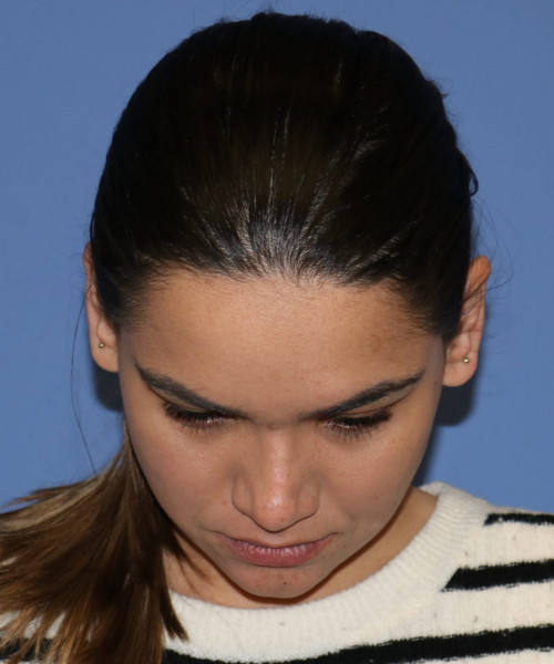 Rhinoplasty 5564 – Click HERE for more views after photo. Individual results may vary.