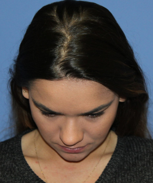 Rhinoplasty 5564 – Click HERE for more views before photo. Individual results may vary.