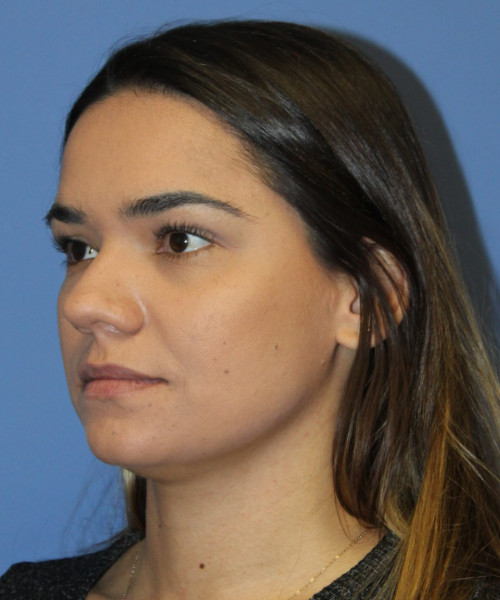 Rhinoplasty 5564 – Click HERE for more views before photo. Individual results may vary.